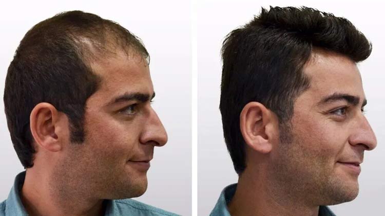 Medications to Avoid Before a Hair Transplant