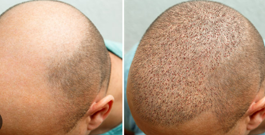 How PRP Treatment For Hair Growth: What To Expect Before, During, And After Is PRP For Hair Loss Safe?