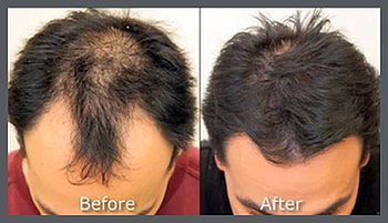 Scalp Micropigmentation for Baldness: Is It the Right Choice